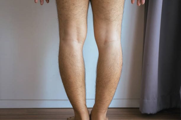 Asian man leg bandy-legged shape of the legs